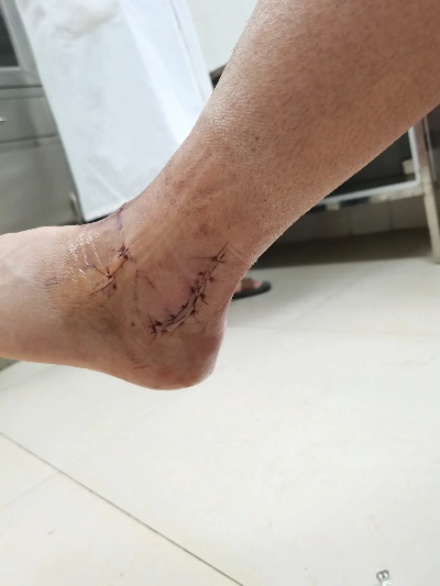 (术后线断了怎么办)断了线gl(纯百)骨科手术后康复注意事项与方法分享