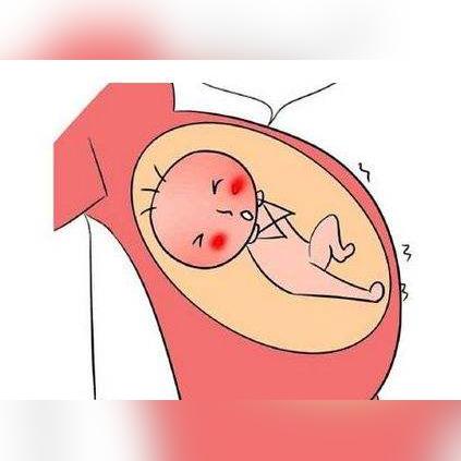 (血hcg刚好为5)HCG值刚好是5，代表怀孕或其他疾病？