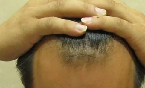 (两额角脱发严重,有什么可以改善的方法?)两侧额角秃发 究竟该怎么解决？