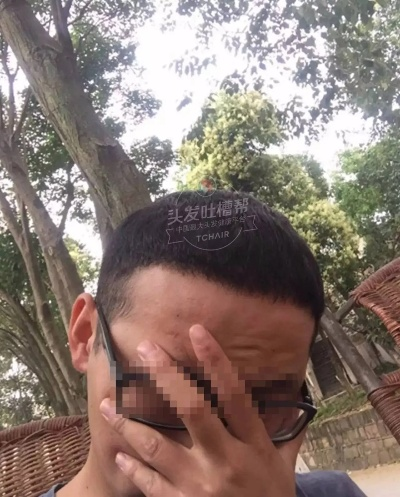 (两额角脱发严重,有什么可以改善的方法?)两侧额角秃发 究竟该怎么解决？