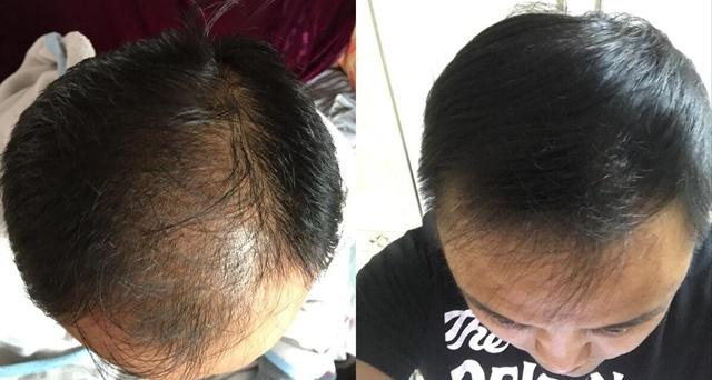 (两额角脱发严重,有什么可以改善的方法?)两侧额角秃发 究竟该怎么解决？